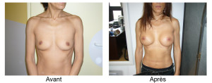 Augmentation mammaire