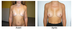 Augmentation mammaire