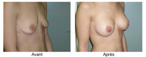 Augmentation mammaire