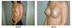 Augmentation mammaire