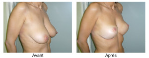 Lifting des seins