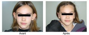 Oreilles décollées enfant