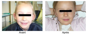 Oreilles décollées enfant