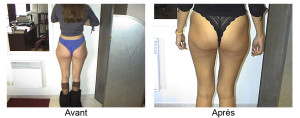 Lipoaspiration