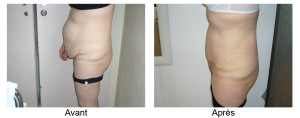 plastie abdominale